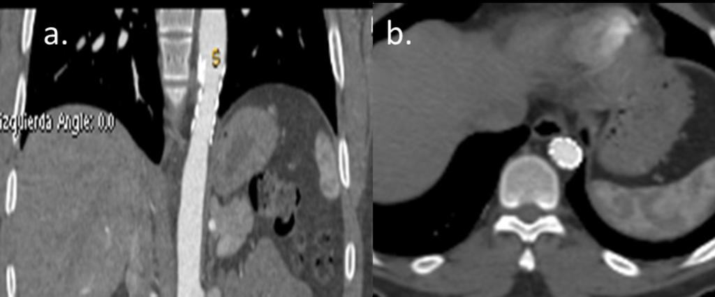Fig. 12: Thoraco-abdominal CT angiography with coronal (a) and axial ( b) images, after