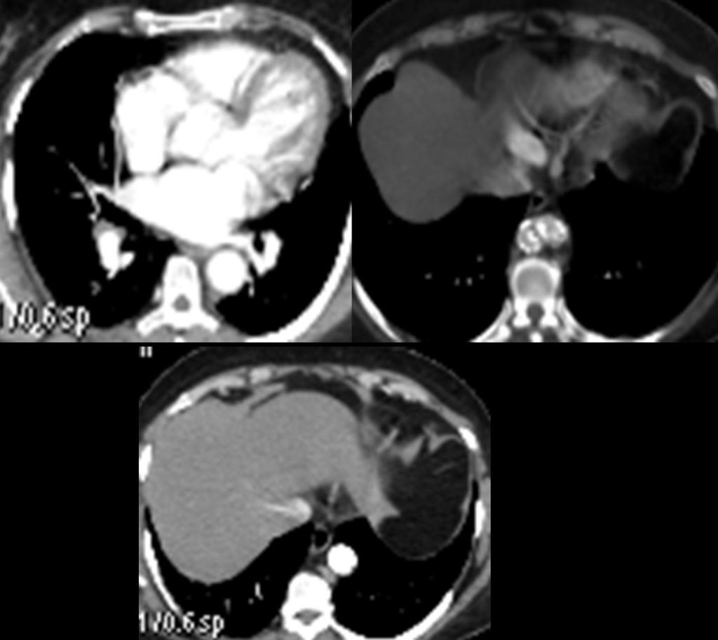 Fig. 16: Consecutive axial slices of thoracoabdominal CT