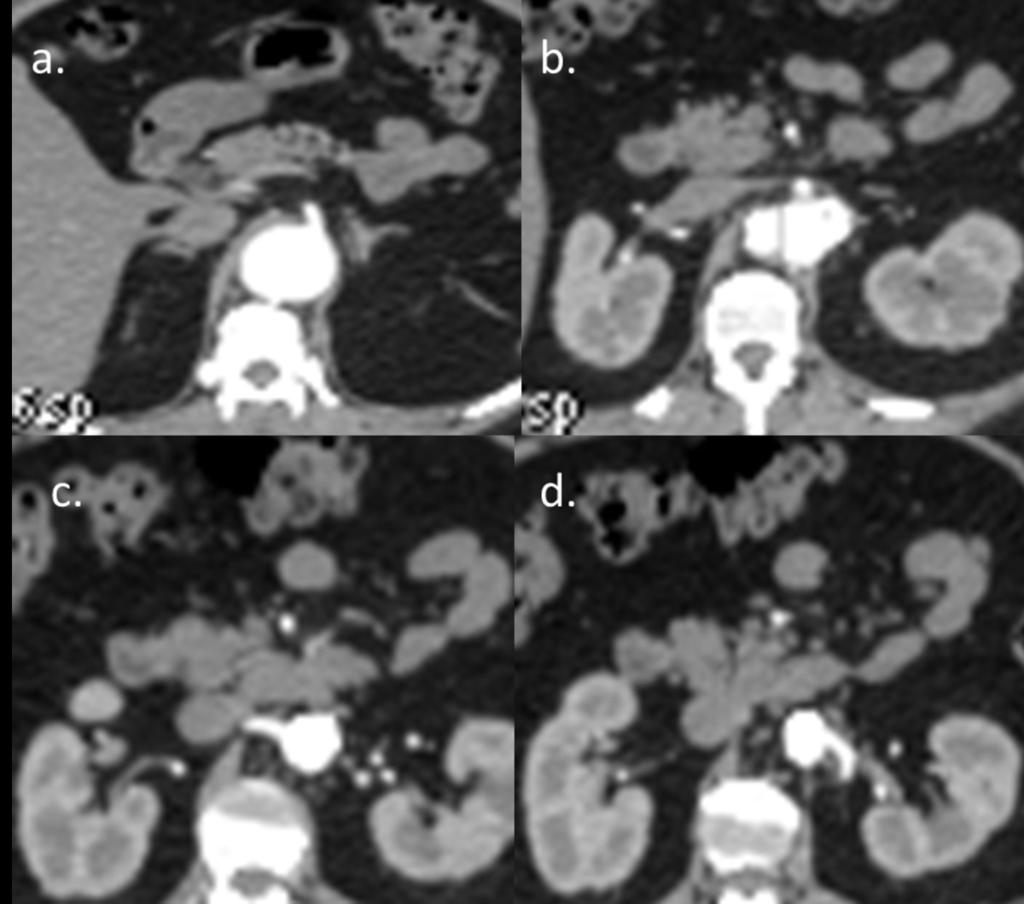 Fig. 17: Abdominal CT angiography with axial images. Permeability of visceral branches and absence of collateral circulation. a. Outflow of the celiac trunk, b.