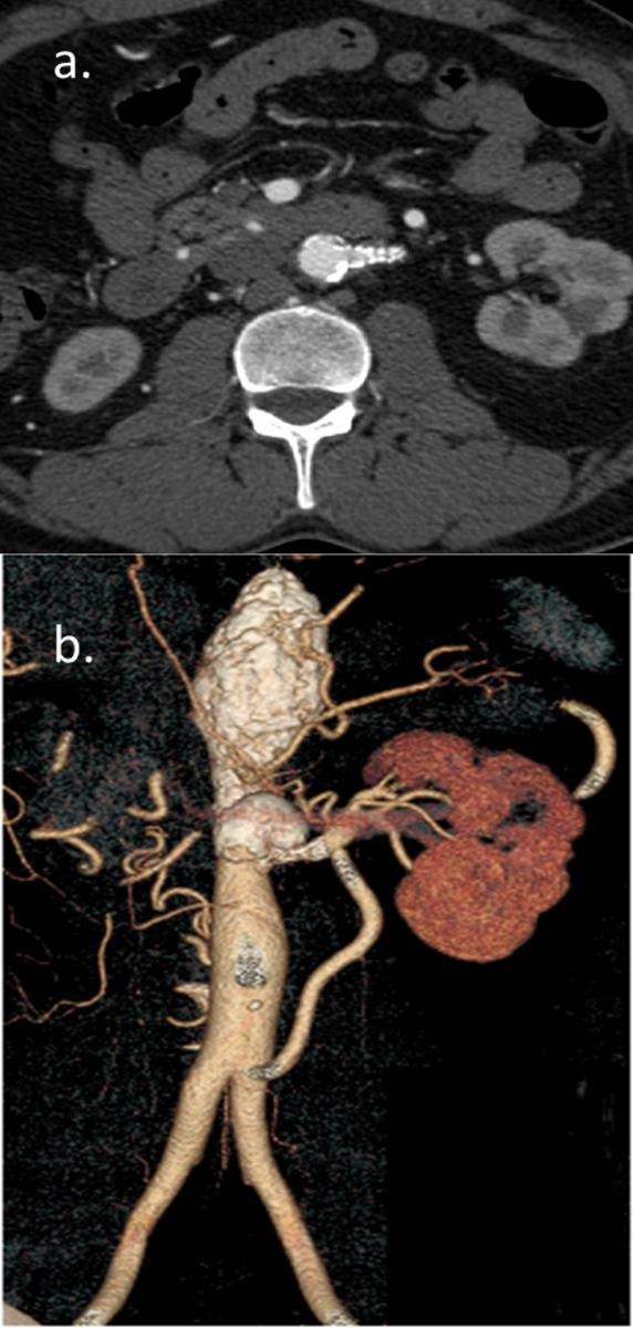 Fig. 5: Abdominal CT angiography post-intervention in axial (a) and 3D