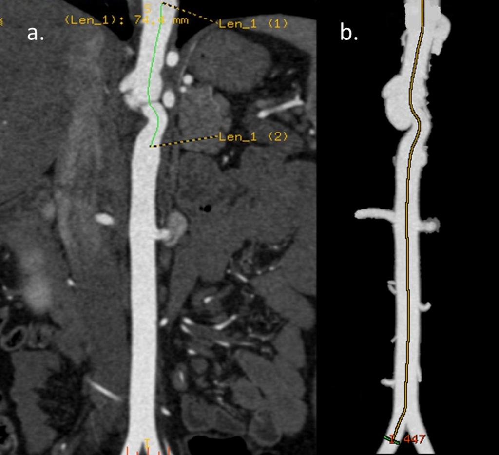 Images for this section: Fig. 6: Case 2. 25 years old woman. Abdominal CT angiography with images in coronal.a and b.