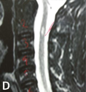 sclerosis. (a) Axial FLAIR image showing hyperintense lesions in the white matter of both hemispheres.