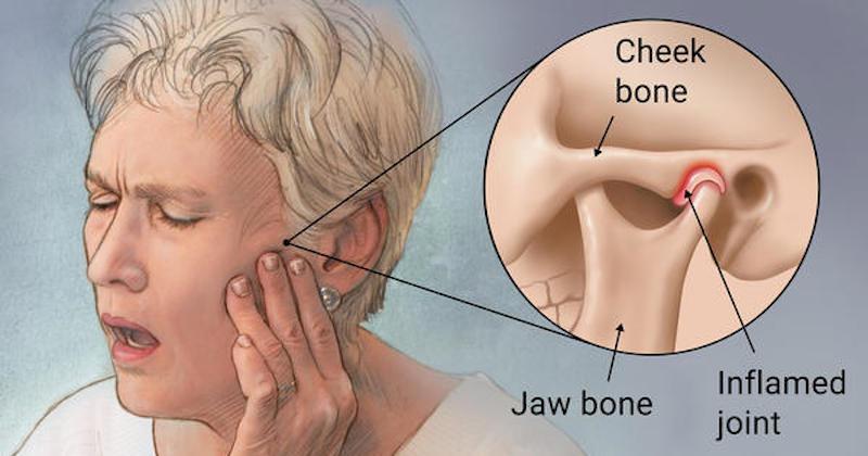 TMJ SYNDROME When this joint is injured or damaged, it can lead to a