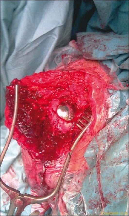 Use of a partial humeral head resurfacing system for