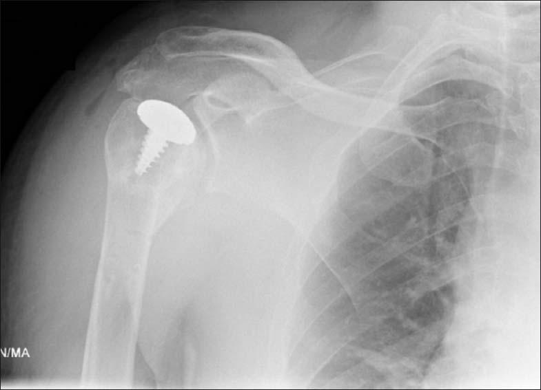 Use of a partial humeral head resurfacing system for management of an osseous mecha.