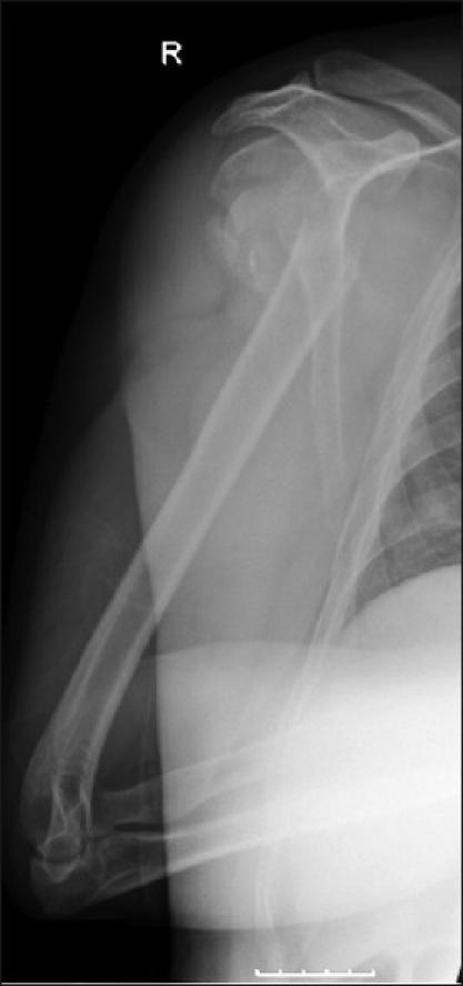 Use of a partial humeral head resurfacing system for management