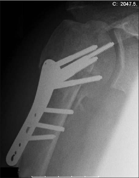 Use of a partial humeral head resurfacing system for management of an osseous mechanic.