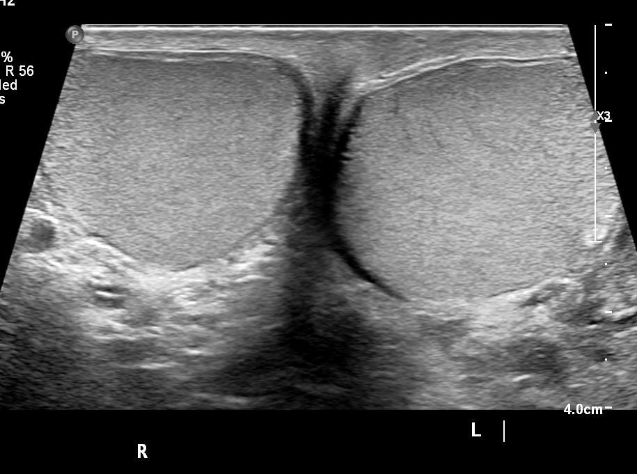 Ultrasound Testicular