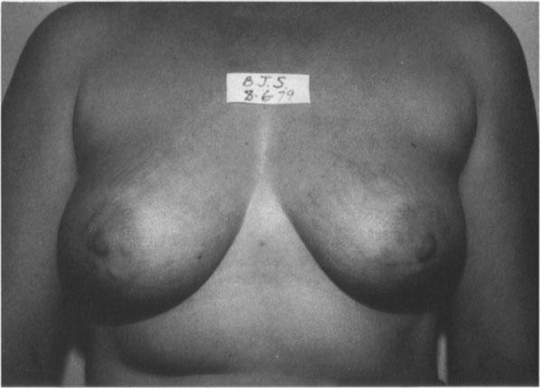 Although she was not concerned, the widening of the scars was an area for improvement. Notice that the areolae did not expand.
