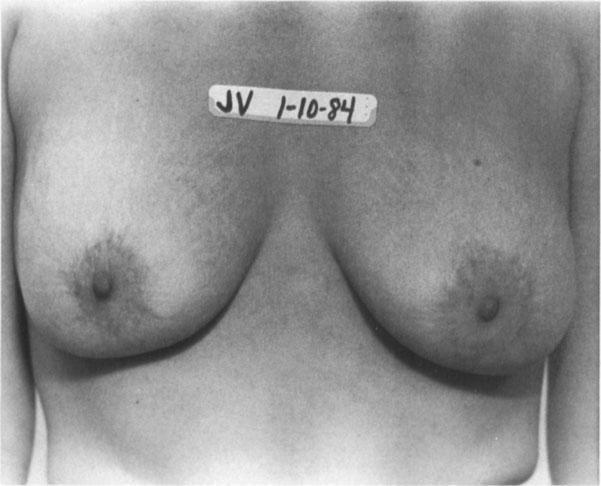 Notice in the prerevision photosome frequency as shown in patient J.V. (A and B).