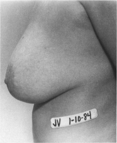 lower portions of the breasts, causing the breast or to the surgical technique, revisions are car-