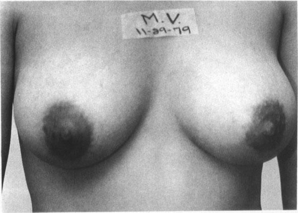 V. underwent an augmentation of moderately ptotic breasts in 1979.