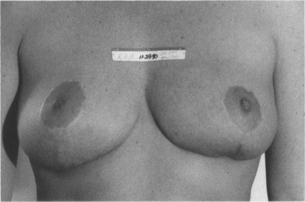 nipples at a lower spot, and adding textured breast prostheses for fullness.