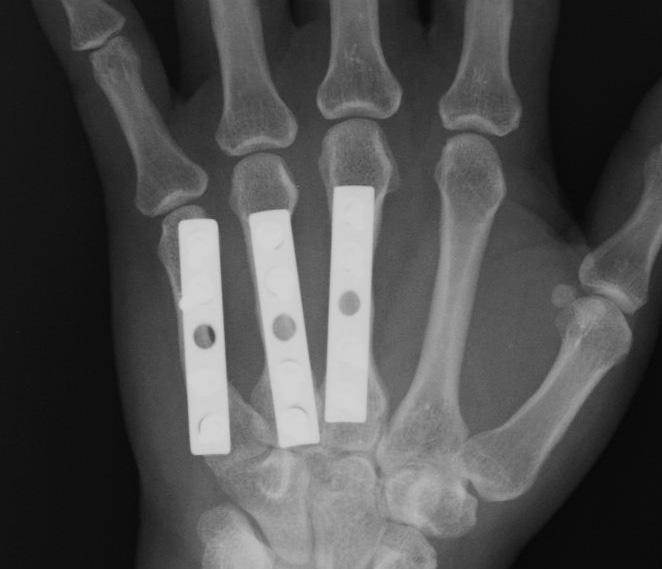 Patient Profile: A 43 year old female presented years after undergoing ORIF of her left 3rd, 4th, and 5th metacarpals at an outside facility.