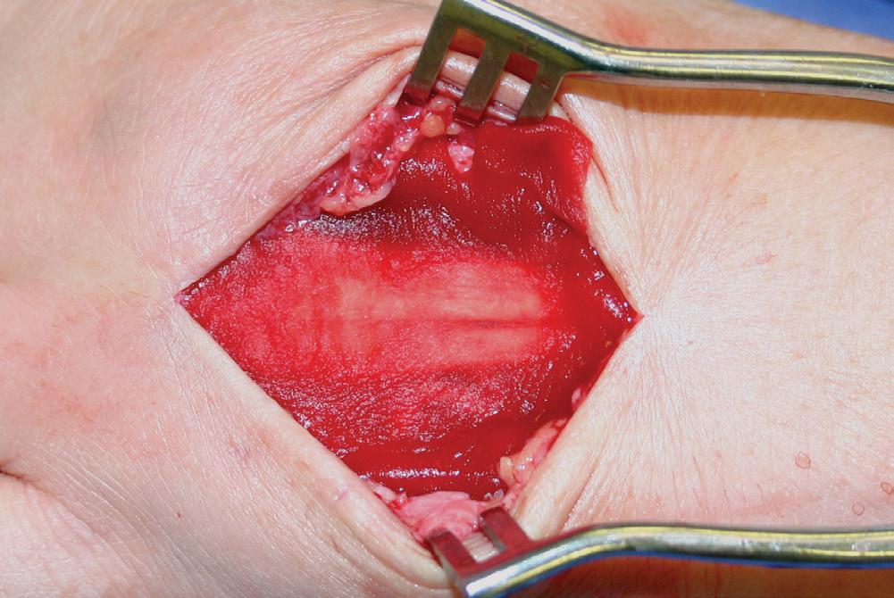 The remaining TenoGlide Tendon Protector Sheet was placed on top of the extensor tendons to act as a barrier between them and the overlying skin and surgical incision [Figure 5].