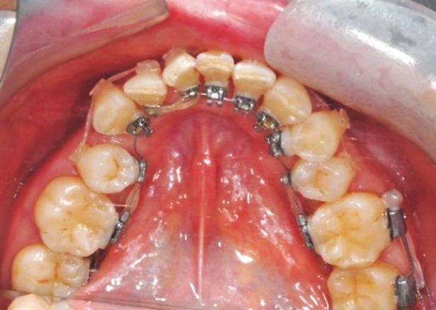 The protrusion and lip incompetency were relieved by the retraction of incisors. The crowding was relieved and all roots are well aligned.