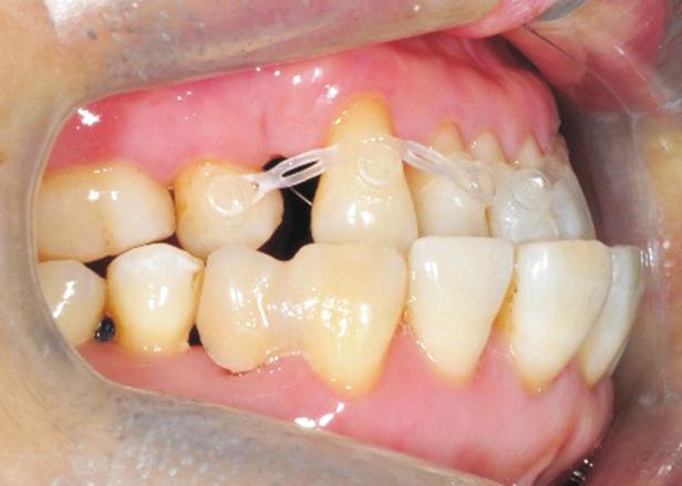 Root resorptions of the upper and lower Incisors were observed in panoramic view. But, there was no remarkable alveolar bone resorption compared to initial recode.