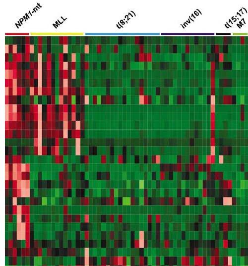HOX Gene Expression in AML with Mutated Nucleophosmin (NPM1c+) Acute Myeloid Leukemia HOXA: MLL-Rearranged AML HOXA ~5-10% t(11q23) Mullighan et al.