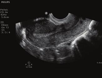 of the abdomen. This image using the C6-2 transducer nicely demonstrates the subtle interfaces of multiple discreet gallstones.