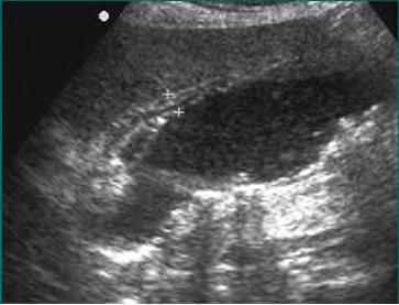 Acute Cholecystitis An acute inflammation of the gallbladder that in 90% of cases, is