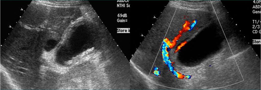 cholecystitis) US Murphy sign: High specificity (> 90%) GB wall thickening (> 4mm)