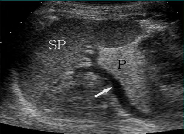 Oblique coronal: for pancreas tail Water ingestion (300~500cc) LAO with stomach as sonic window Right