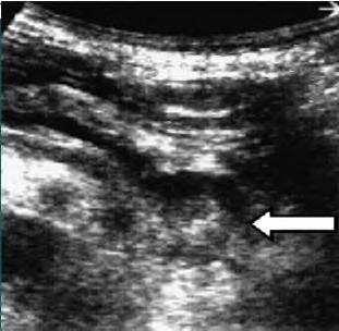 Early sign of pancreatic Ca.