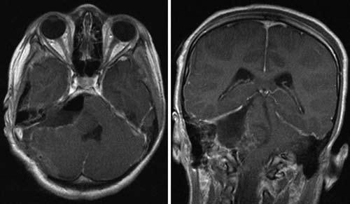 Pediatric vestibular schwannoma Outcome and Follow-Up Several end points were observed with an emphasis on facial nerve function in addition to long-term follow-up for signs and symptoms of a