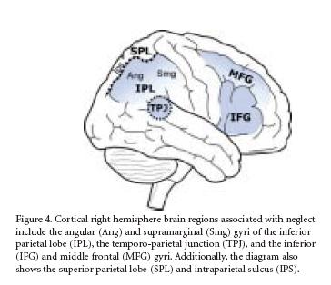 There are 3 main cortical regions of the right hemisphere where damage produces the neglect syndrome: 1)