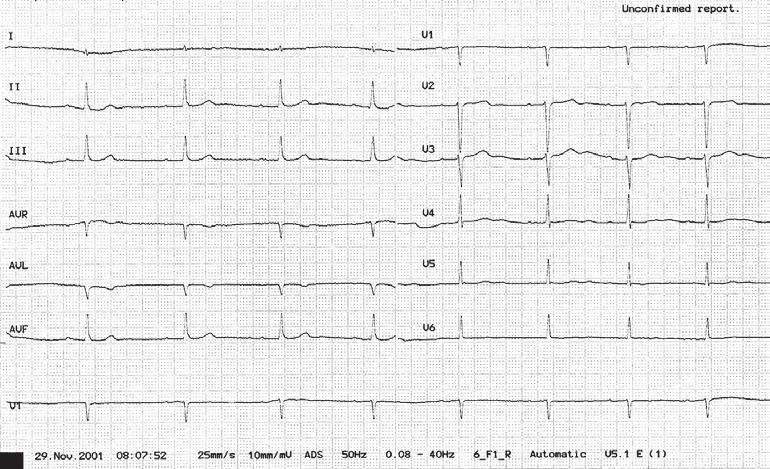 Cardiology Journal 2011, Vol. 18, No. 2 Figure 1. Sinus bradycardia 51 bpm, small amplitude and short duration (0.04 s) of P-waves, first-degree atrioventricular block.