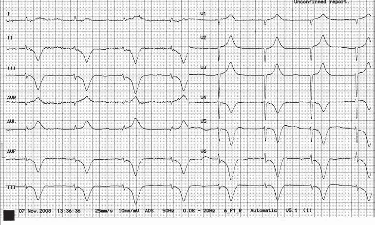 Beata Wożakowska-Kapłon, Dawid Bąkowski, Progression of cardiac disease in myotonic dystrophy Figure 2. Atrioventricular junctional rhythm 44 bpm, P-waves are missing. Figure 3.