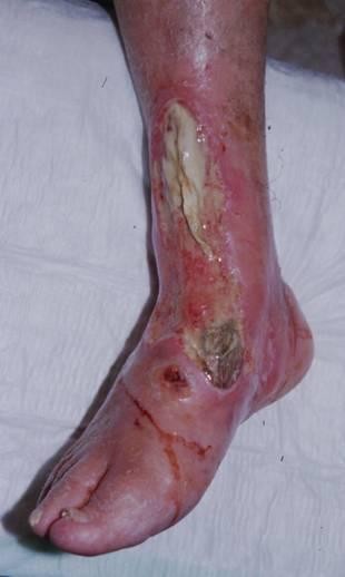 Skin, tissue damage and arterial