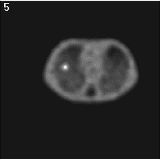 0% (msv) 20 15 10 Scintigraphy Hybrid Complicated radiological Simple X-ray