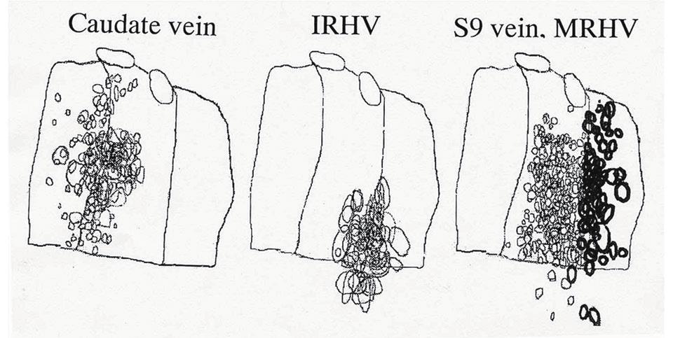 Kimura, Fukumoto, Watanabe, Hirai hepatic portion of the inferior vena cava.