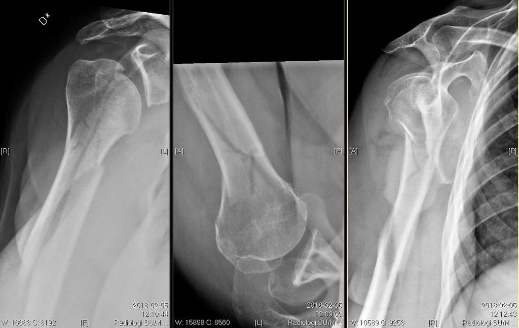 Complex humeral fracture?