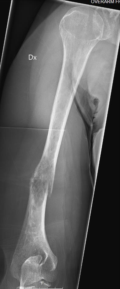 Complex humeral fracture?