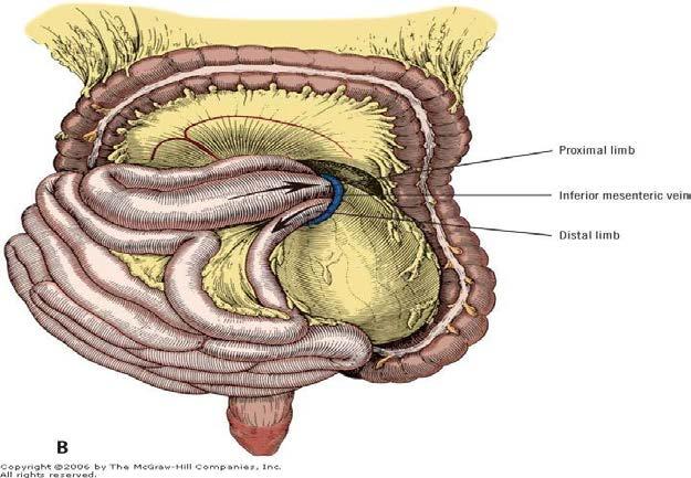 Left Paraduodenal hernia Left paraduodenal hernias have an overall incidence of approximately 40% of all internal hernias.