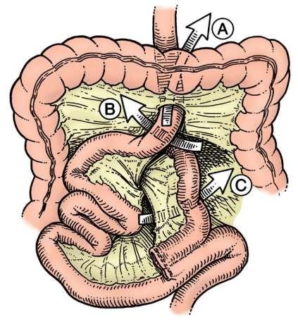 2. The Petersen defect (arrow B), Petersen hernias are internal hernias which occur in the potential space posterior to a gastrojejunostomy.
