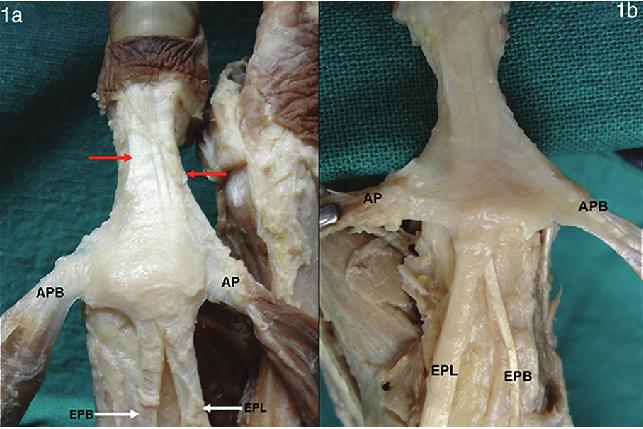 Dorsal Digital Expansion Of Thumb...Joshi, S.S., Joshi, S.D., Aavale S.A., Kishve, P. S. and Jadhav S.D. (fig.1a,b). The base was directed proximally covering e dorsal aspect of MP joint as a hood.