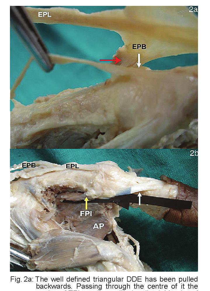 Red arrows indicate e lateral and medial borders of DDE. The apex of DDE which is broad is getting attached to dorsal surface of terminal phalanx. Fig.