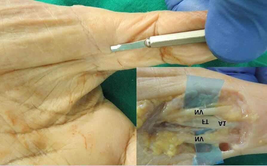It is becoming more popular than open surgery. In his study, Elsayed 15 observed a high success rate (97%) of percutaneous release with 40 fingers.