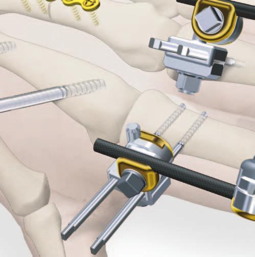 facilitate fracture alignment and
