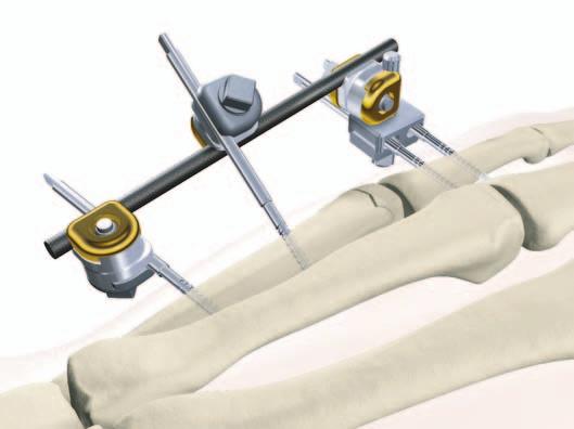 Indications & Contraindications Relative Indications The Hoffmann II Micro System is indicated for hand fractures.
