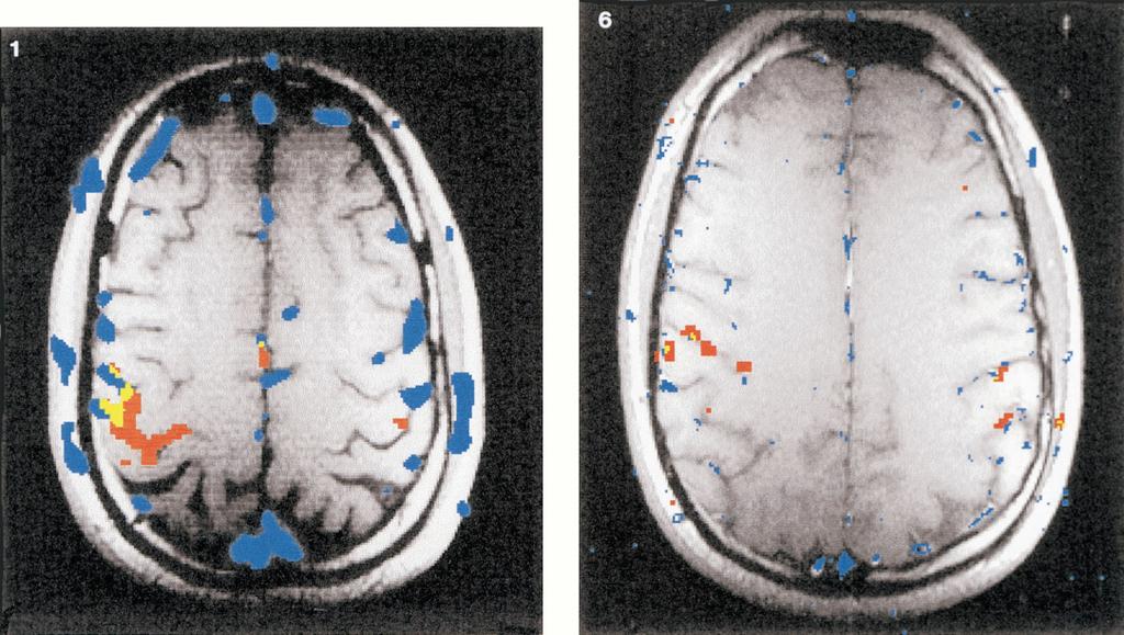 SUPPRESSION OF MACROVASCULAR SIGNALS IN fmri 227 FIG. 1. Axial slice through the primary motor cortical hand area activated with left (dominant) finger movement.