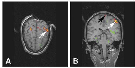 Intra-operative real-time fmri BUT: functional brain networks can