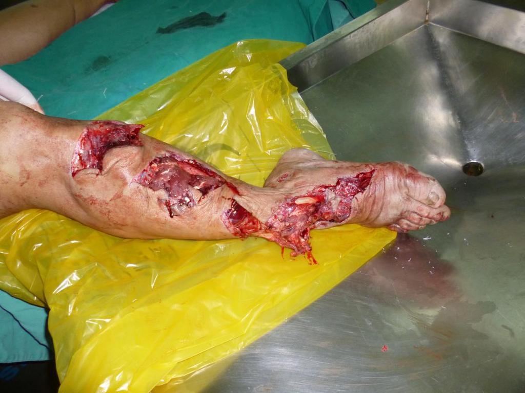 Transplantation Treatment of Extensive Soft-Tissue Defects in Lower Extremities The Open Orthopaedics Journal, 2017, Volume 11 705 innovative method.