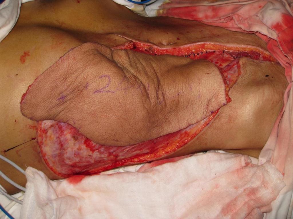 umbilical flap, c: the harvested combined flap, d:the combined flap was temporarily sutured to the donated area of anterolateral thigh perforator flap). Fig. (4b).