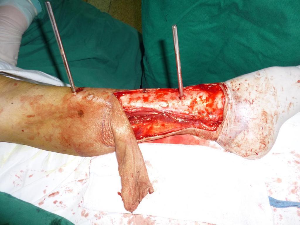 crossleg external fixation and the anostomosis between cross-bride flap and combined flap). Fig. (5b).
