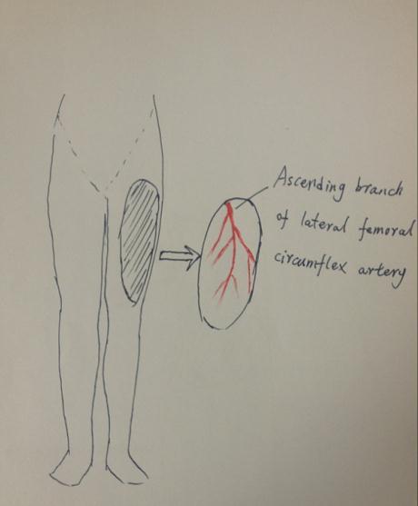 The procedure of cross-leg flap transplantation (a: the design of cross-leg