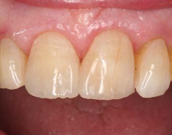A thin layer of enamel composite (G-ænial AE) is applied with a flat, slightly moistened